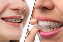 Are Braces Cheaper Than Invisalign Are Braces Cheaper Than Invisalign