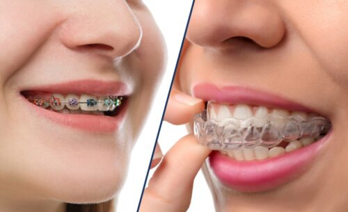 Are Braces Cheaper Than Invisalign